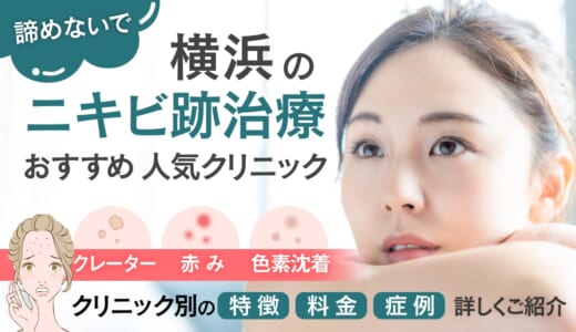 横浜でニキビ跡の治療ができる人気クリニック10選！安くて評判の良いクリニックの特徴や料金をご紹介！